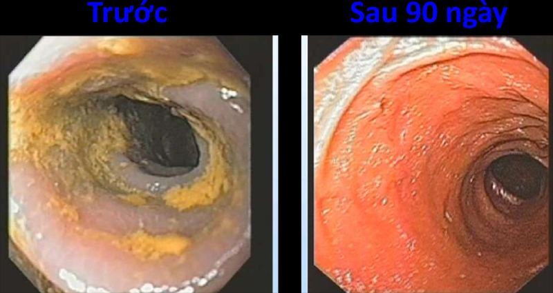Bác sĩ Hiromi Shinya cho bệnh nhân dùng nước Kangen để hỗ trợ điều trị bệnh đường ruột. Hình ảnh ruột trước khi dùng nước Kangen (bên trái) thành ruột bám dày đặc chất bẩn. Hình ảnh ruột trước sau 90 dùng nước Kangen (bên phải) thành ruột sạch sẽ và hồng hào.