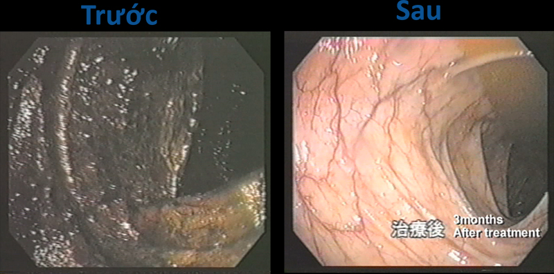 Bác sĩ Hiromi Shinya cho bệnh nhân dùng nước Kangen để hỗ trợ điều trị bệnh ung thư. Hình ảnh ruột trước khi dùng nước Kangen (bên trái) thành có màu đen. Hình ảnh ruột trước sau 90 dùng nước Kangen (bên phải) thành ruột sáng màu hơn, hồng hào hơn.